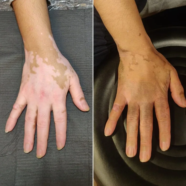 Tattoo Instead of Treatment: The Revolutionary Mini Patankar Method for Covering Vitiligo - image 3
