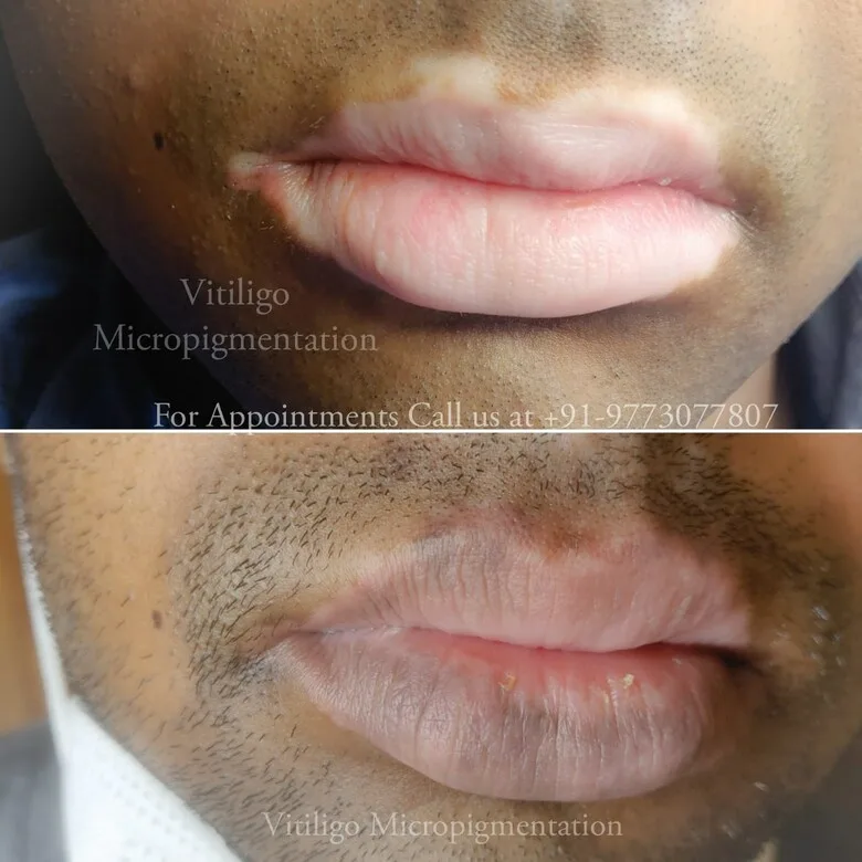 Tattoo Instead of Treatment: The Revolutionary Mini Patankar Method for Covering Vitiligo - image 2