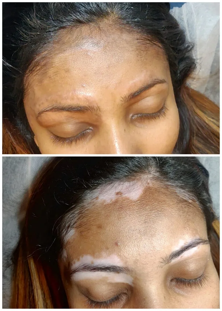 vitiligo micropigmentation