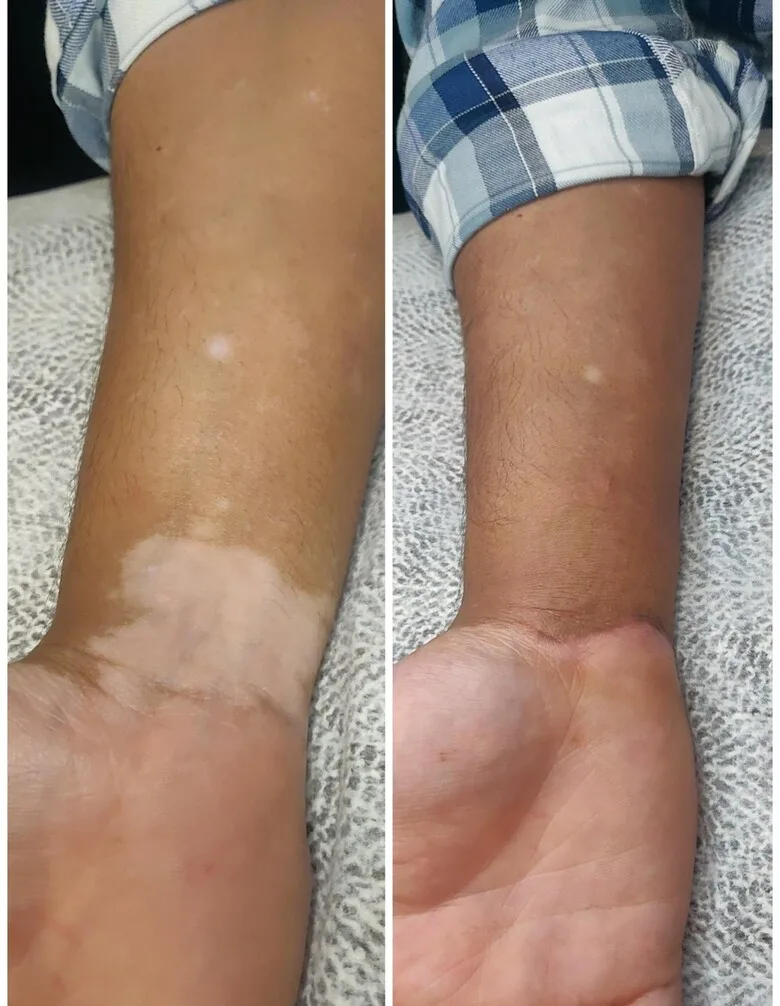 Tattoo Instead of Treatment: The Revolutionary Mini Patankar Method for Covering Vitiligo - image 1