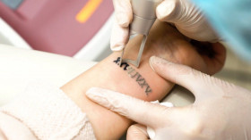 Лазерное удаление татуировки - безопасный способ избавиться от неудачного рисунка