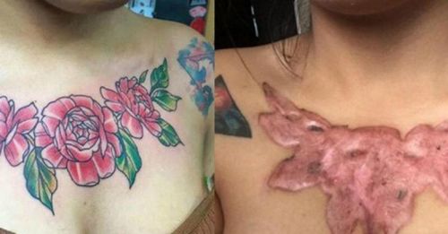 Три способа удалить старую татуировку
