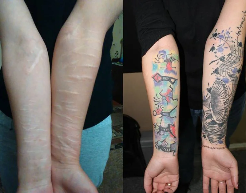 Scars & Ink: Todos os Dados que Voc&ecirc; Precisa Sobre Cobrir uma Ferida com Tatuagem