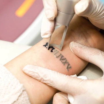 Лазерное удаление татуировки - безопасный способ избавиться от неудачного рисунка