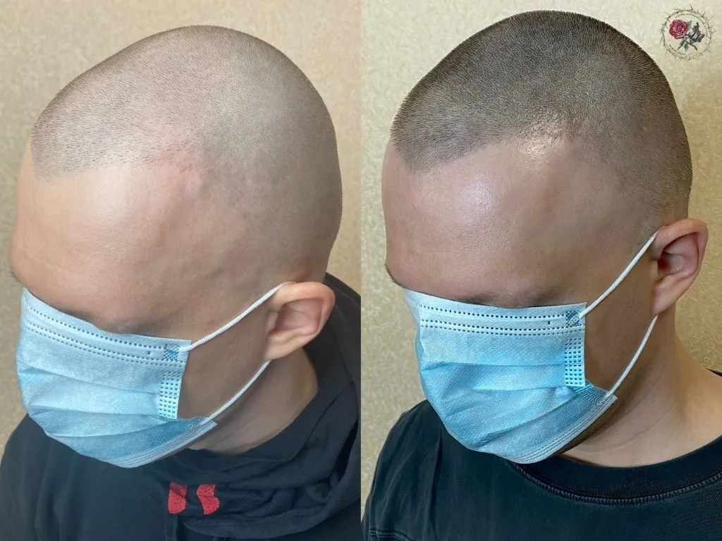 Tattoo hair on the head with baldness