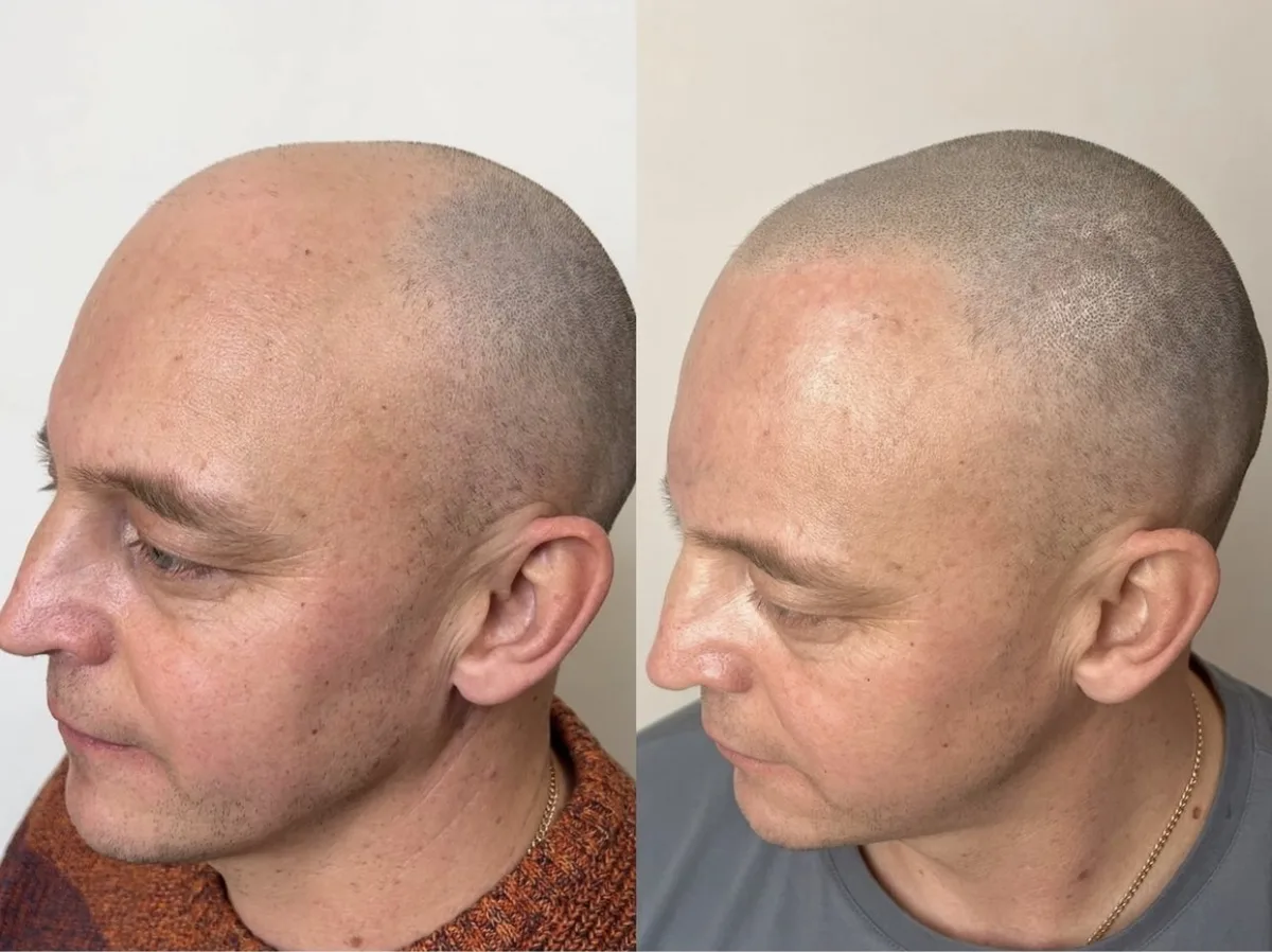 Hair tattoo for male pattern baldness