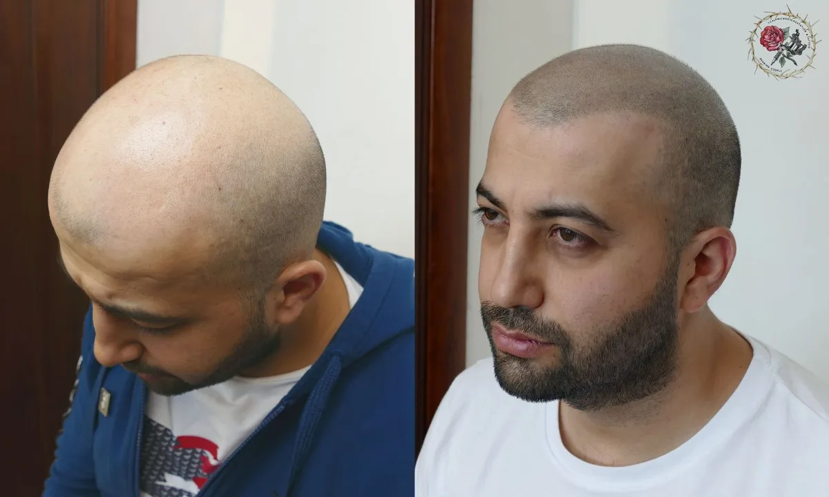 Hair tattoo for baldness on the example of the work of Andrey Afanasiev