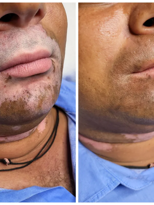 black and grey Tatuaggio su face #91485 | Tatuatore Mini Patankar