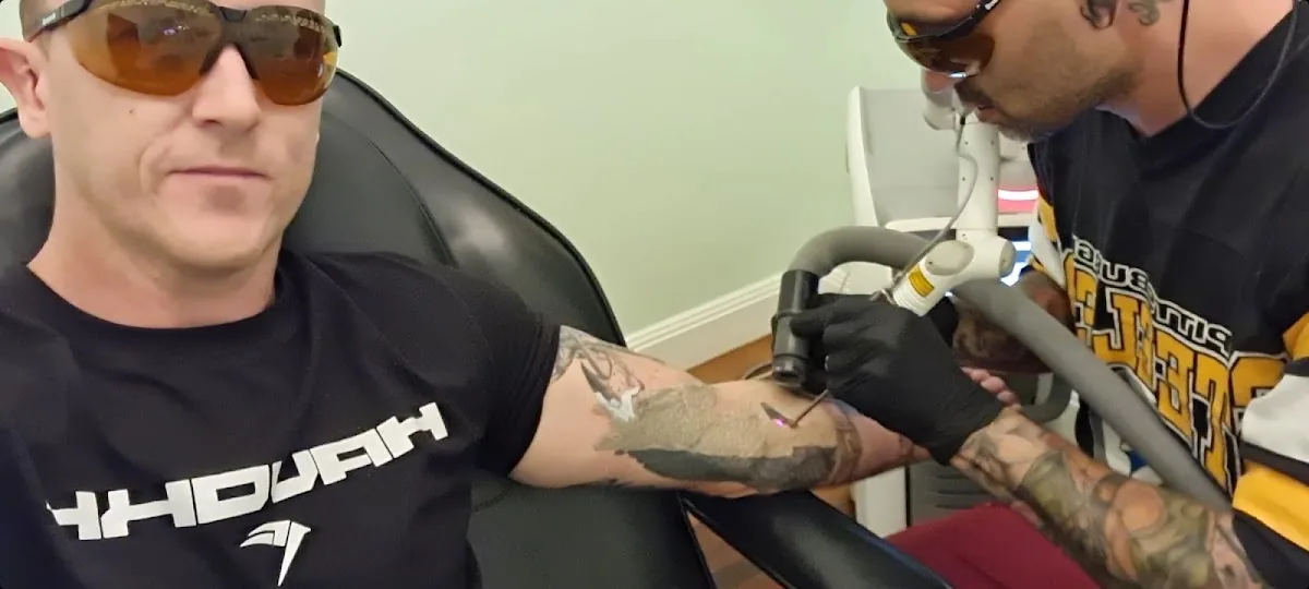 Tattoo by Counterpunch Tattoo Removal at Counterpunch Tattoo Removal