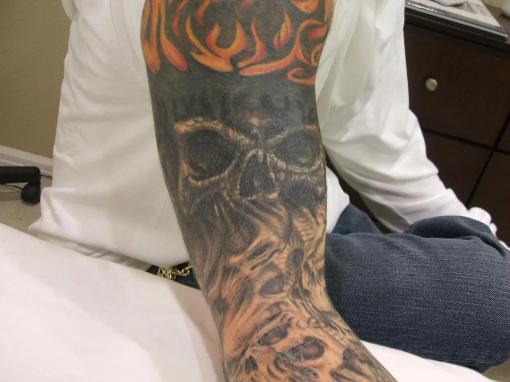 Tattoo by INK B GONE Tattoo Removal Denver at INK B GONE Tattoo Removal Denver