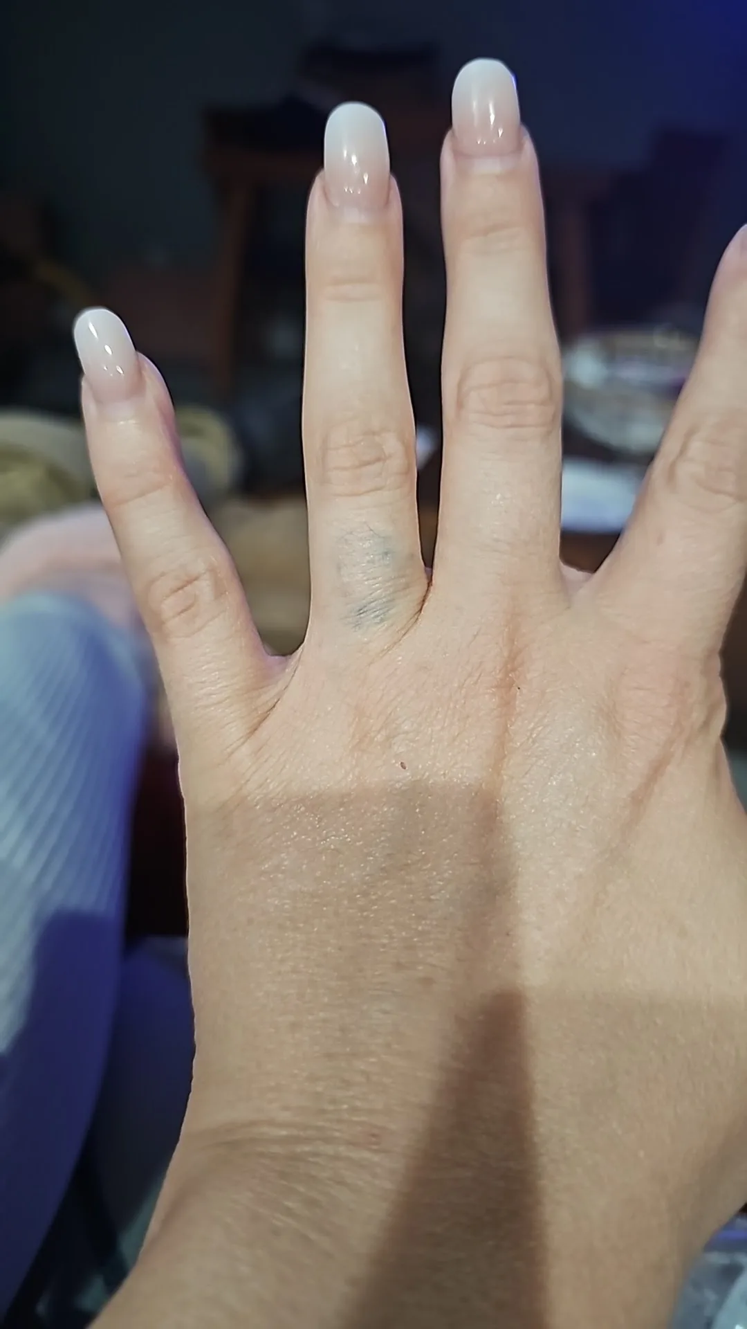 Tattoo by INK B GONE Tattoo Removal Denver at INK B GONE Tattoo Removal Denver