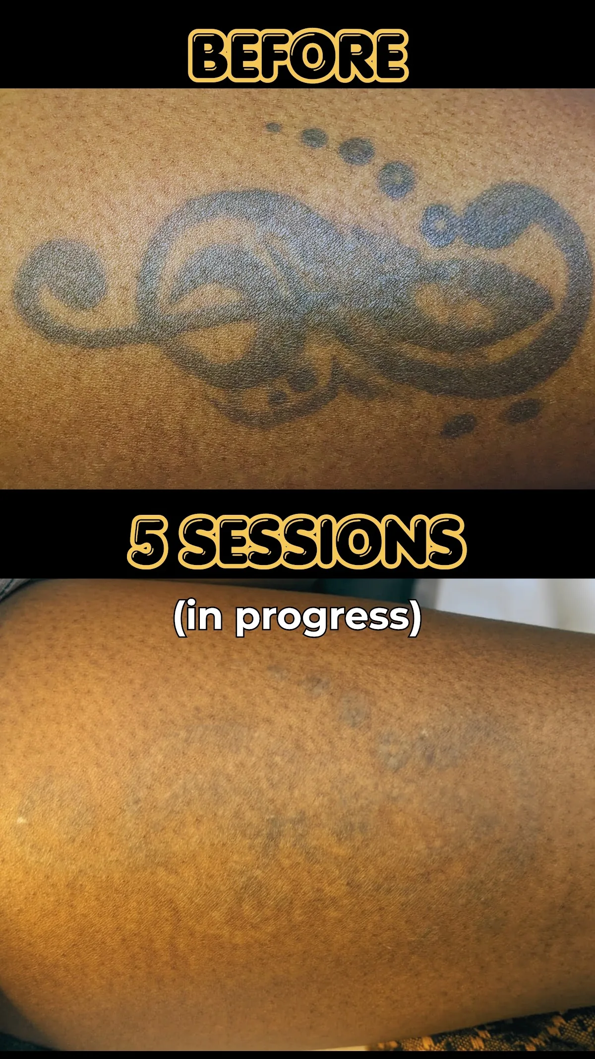 Tattoo by Inkless is More, Nairobi Laser Tattoo Removal Studio at Inkless is More, Nairobi Laser Tattoo Removal Studio