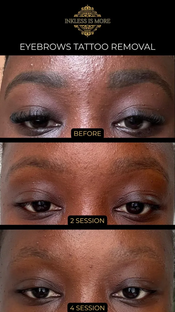 Tattoo by Inkless is More, Nairobi Laser Tattoo Removal Studio at Inkless is More, Nairobi Laser Tattoo Removal Studio