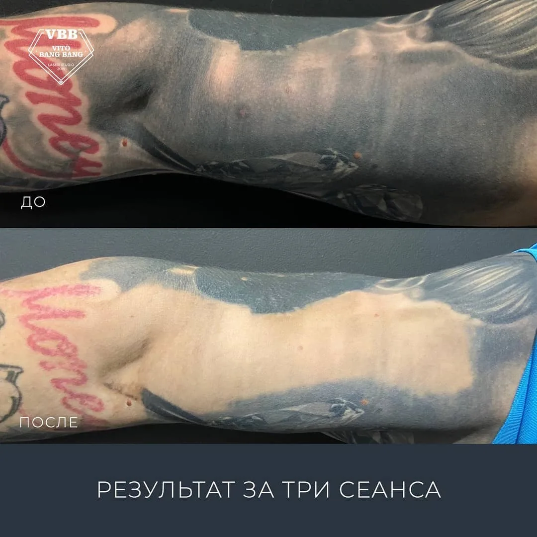 Tattoo by Кабинет удаления татуировок at Кабинет удаления татуировок