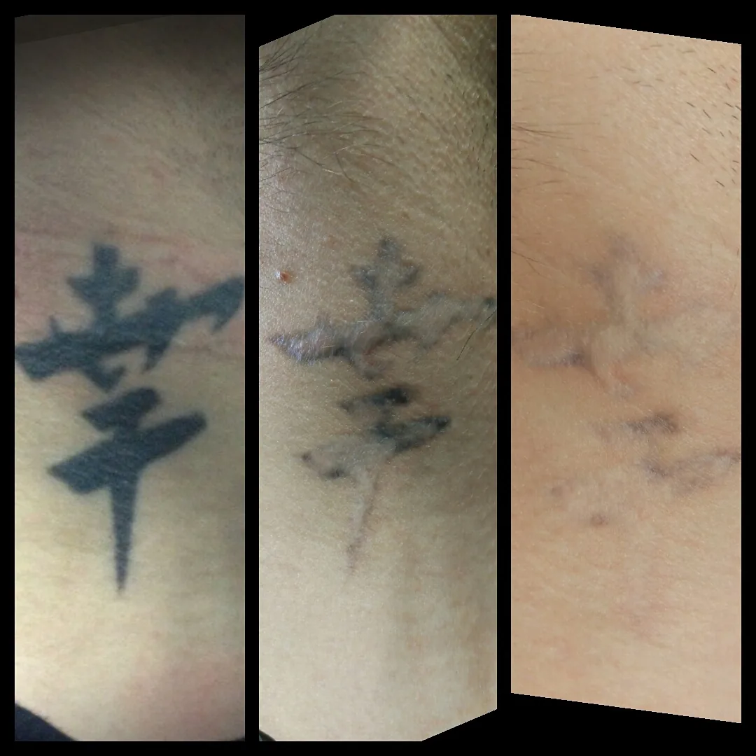 Tattoo by Неодим, салон по удалению татуировок at Неодим, салон по удалению татуировок