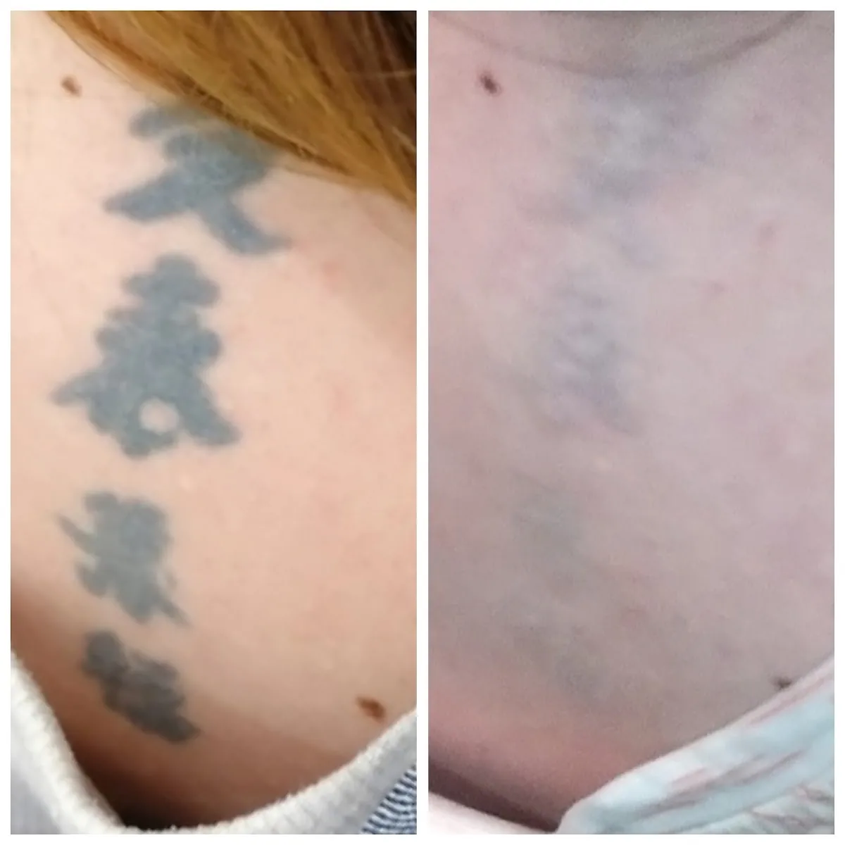 Tattoo by Неодим, салон по удалению татуировок at Неодим, салон по удалению татуировок