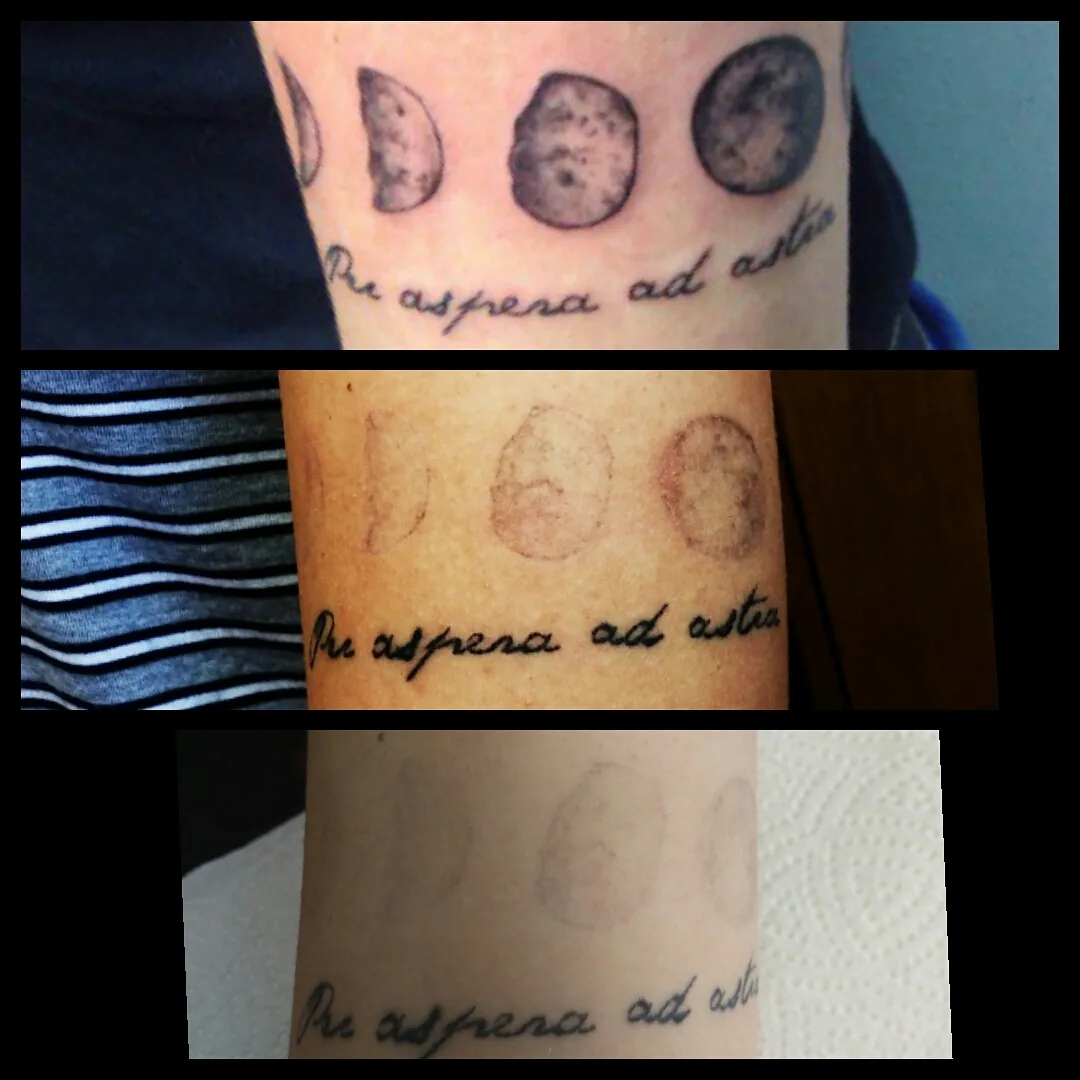 Tattoo by Неодим, салон по удалению татуировок at Неодим, салон по удалению татуировок