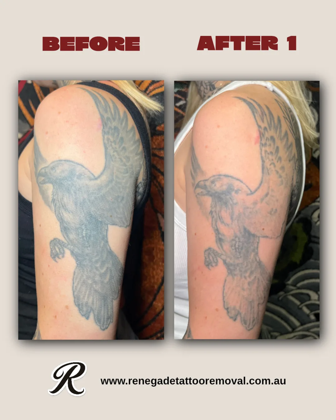 Tattoo by Renegade Tattoo Removal at Renegade Tattoo Removal
