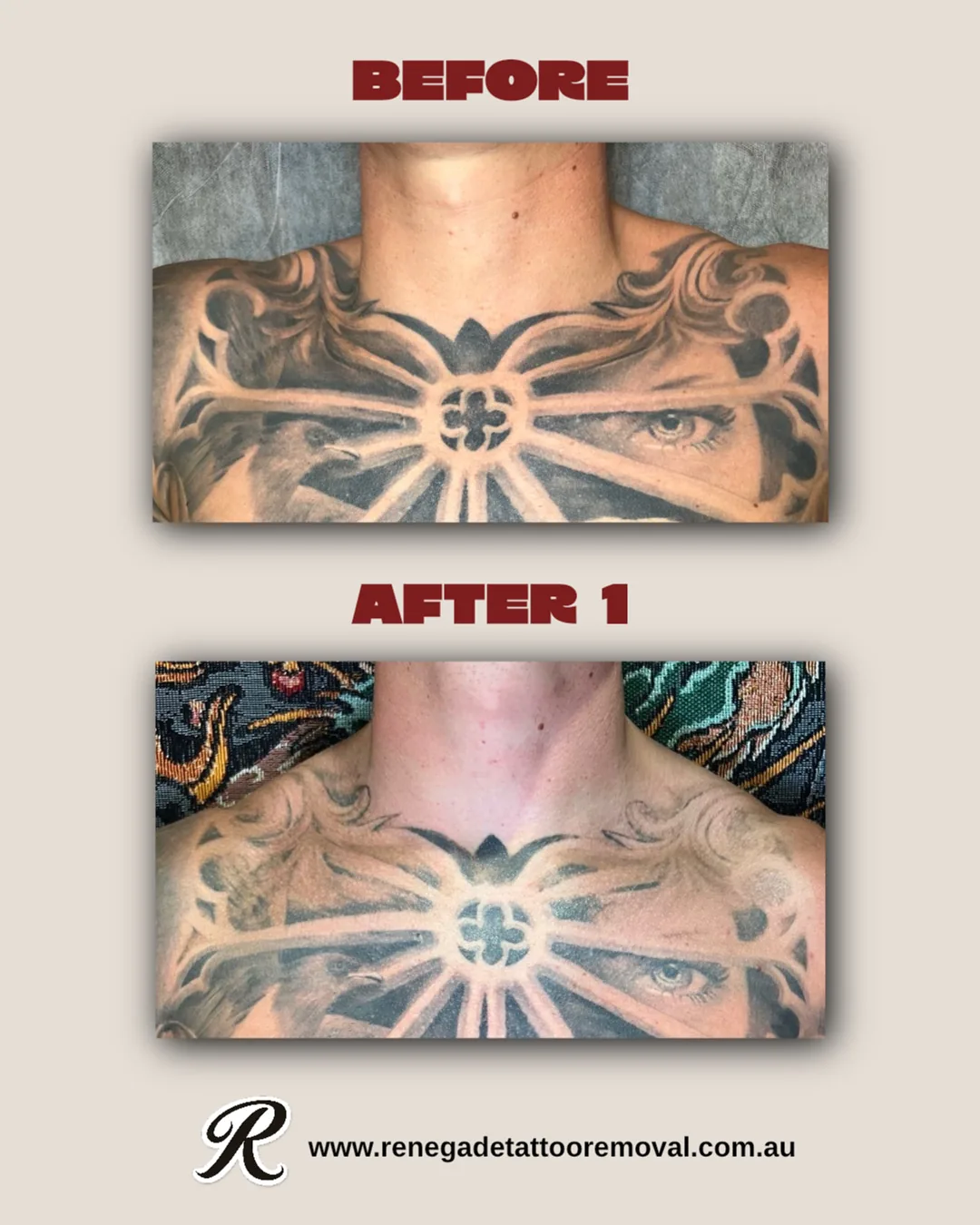 Tattoo by Renegade Tattoo Removal at Renegade Tattoo Removal