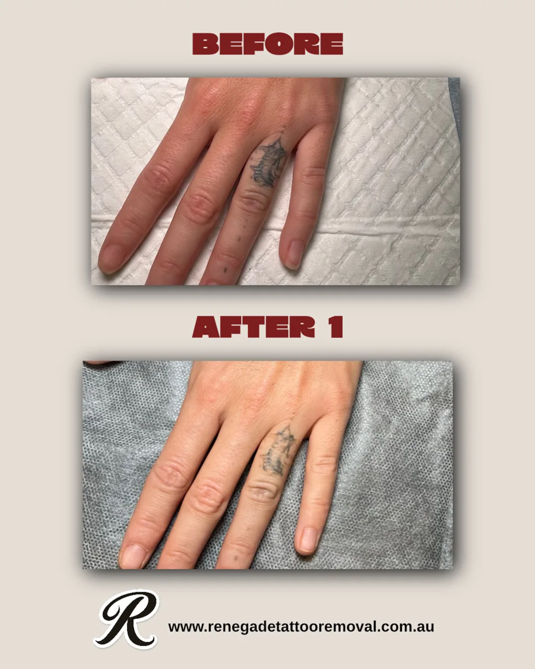 Tattoo by Renegade Tattoo Removal at Renegade Tattoo Removal