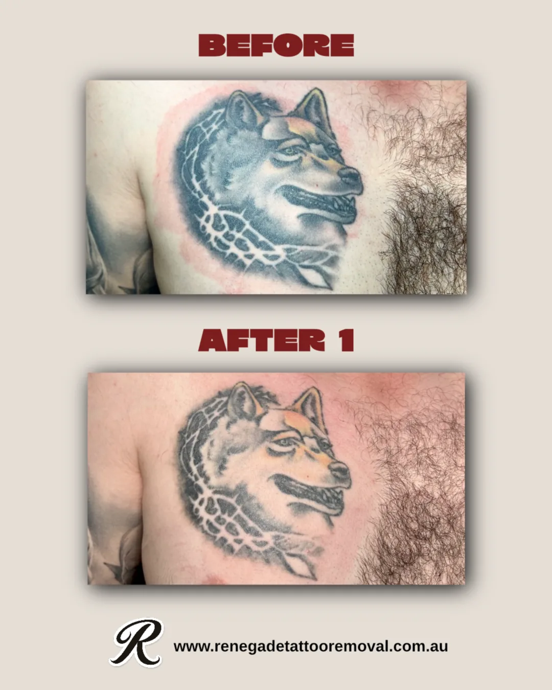 Tattoo by Renegade Tattoo Removal at Renegade Tattoo Removal