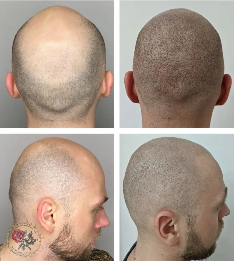 Tricopigmentazione in alopecia