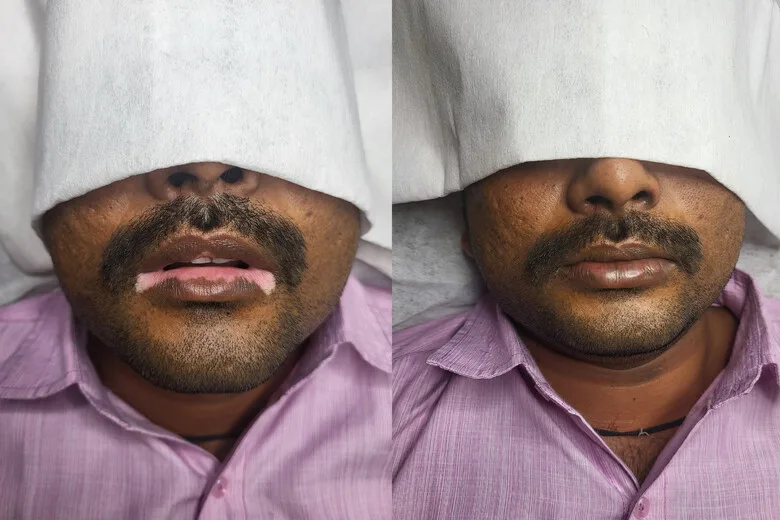 vitiligo micropigmentation
