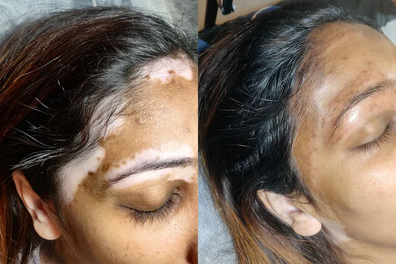 vitiligo micropigmentation