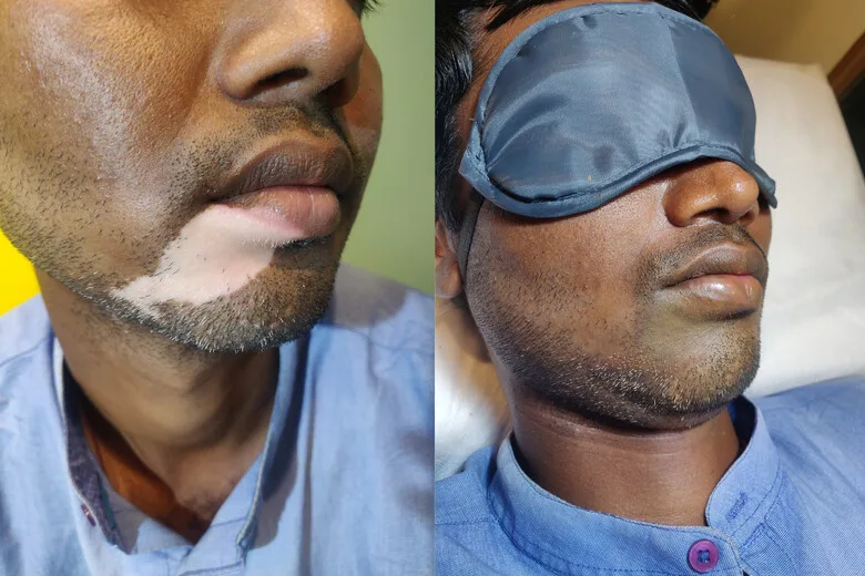vitiligo paramedical tattooing