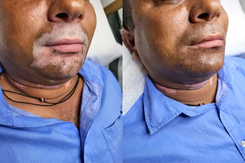 vitiligo micropigmentation