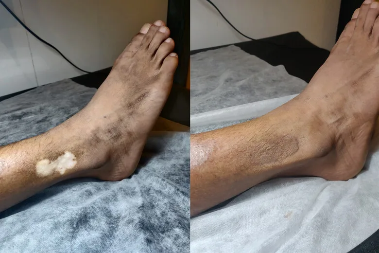 vitiligo micropigmentation