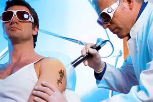 Laser-Tattooentfernung