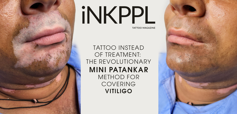 Tattoo Instead of Treatment: The Revolutionary Mini Patankar Method for Covering Vitiligo