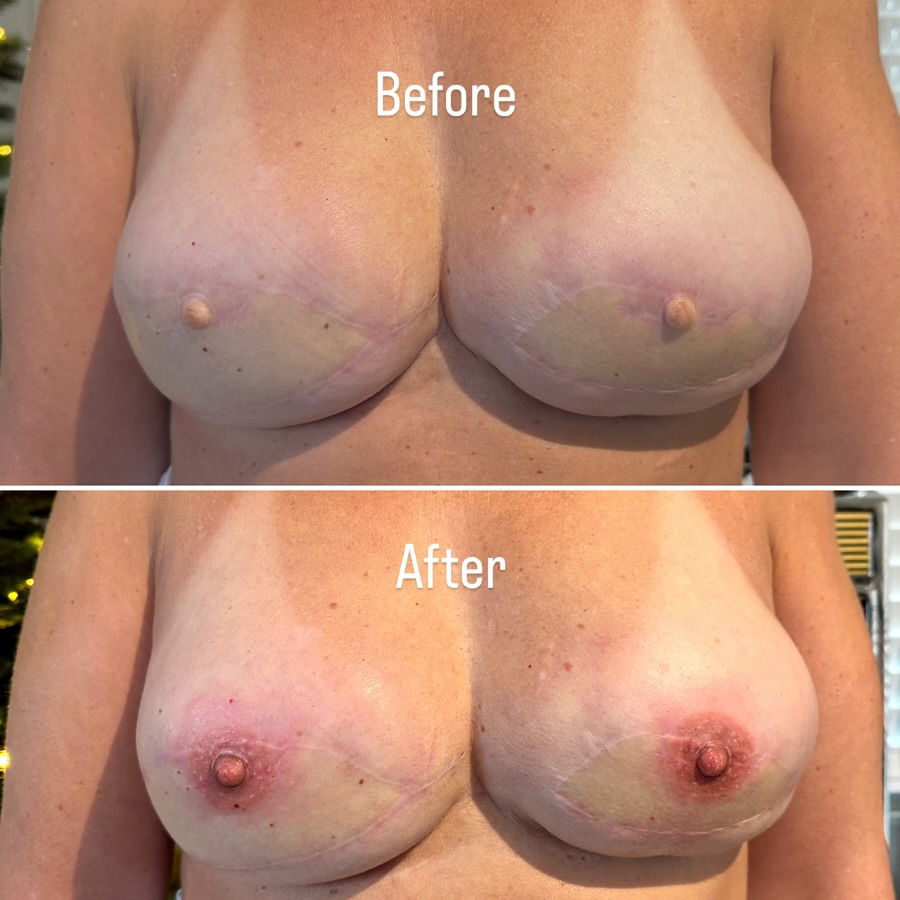 Areola and Nipple tattoo Reconstruction