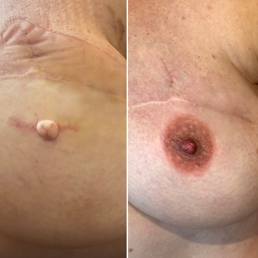 Areola and Nipple Tattoo Reconstruction