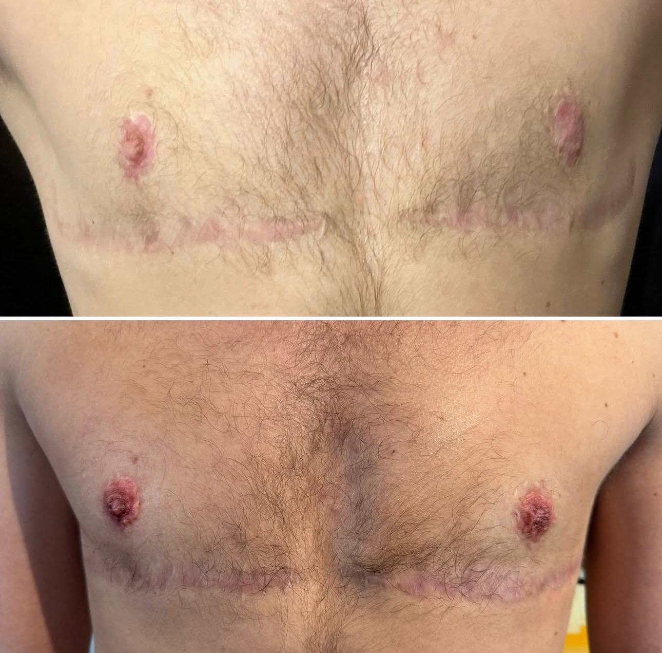 Areola and Nipple Tattoo Reconstruction