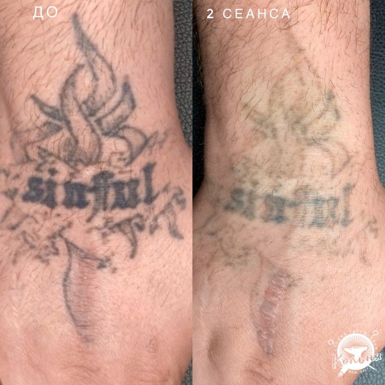 пример удаления тату лазером за 2 сеанса