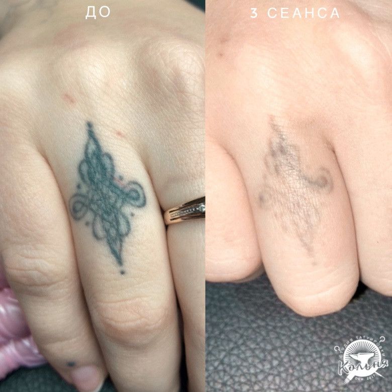 пример лазерного удаления некачественной тату