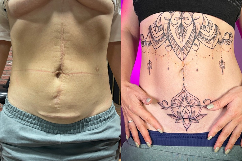  маскировка шрама татуировкой - Дмитрий Палкин 