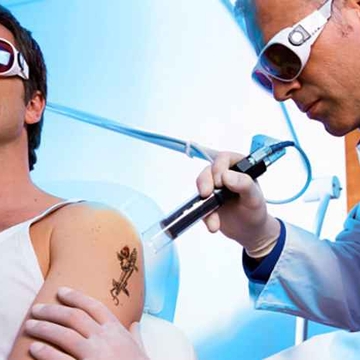 Eliminación láser de tatuajes — Sesiones, dolor, riesgos y resultados explicados