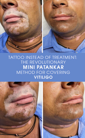 Tatuaggio invece di trattamento: Il metodo rivoluzionario mini Patankar per coprire il vitiligine