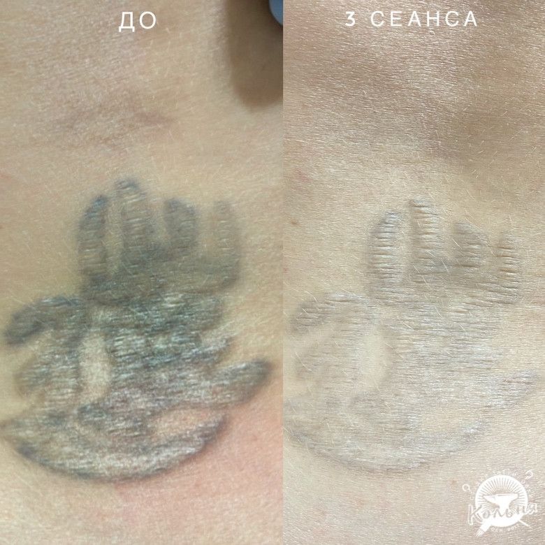 пример лазерного удаления некачественной тату