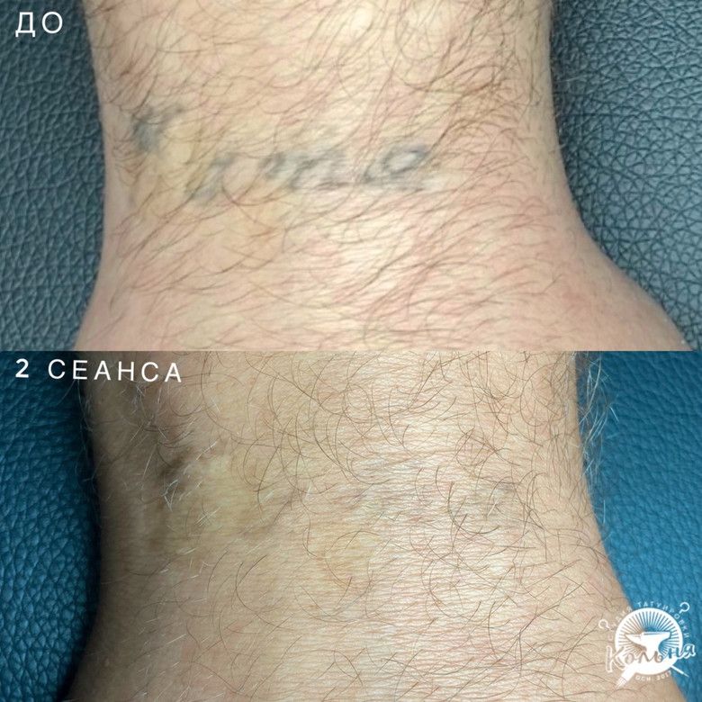 пример лазерного удаления некачественной тату