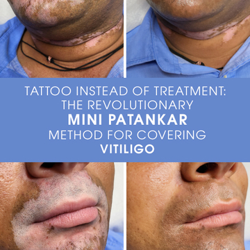Tatuagem Em vez de Tratamento: O Método Revolucionário Mini Patankar para Cobrir Vitiligo