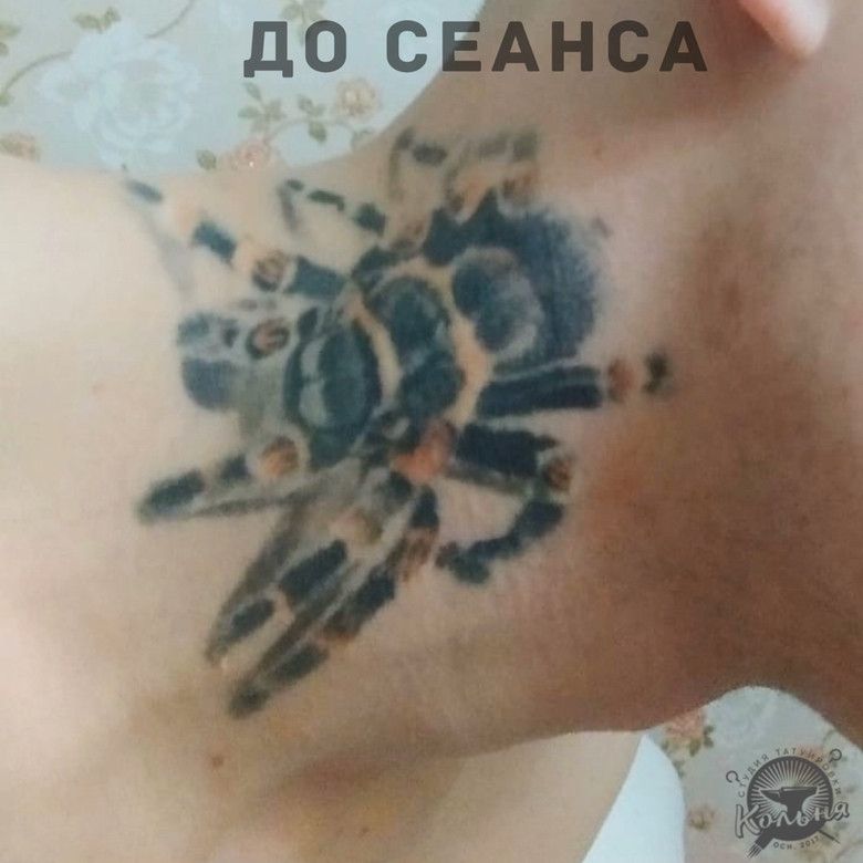 пример удаления татуировки лазером за 4 сеанса