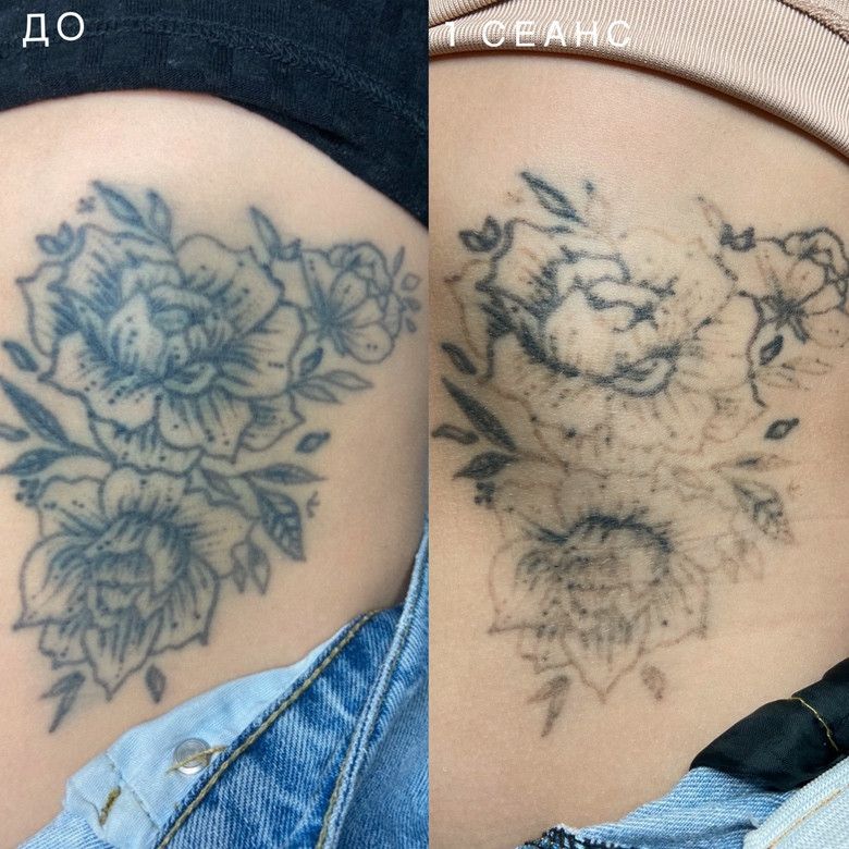 пример удаления тату лазером за 1 сеанса