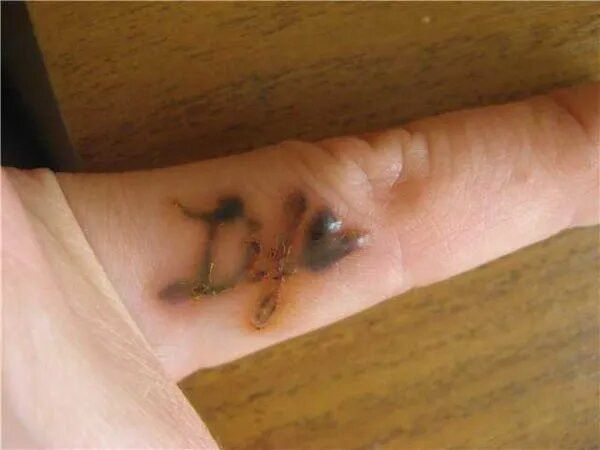 Удаление татуировки на руке йодом
