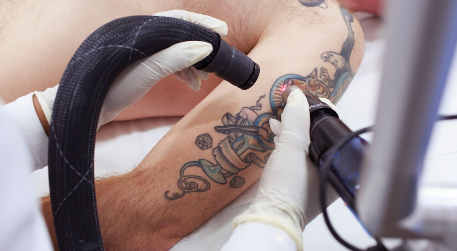 Удаление татуировки 3 способами