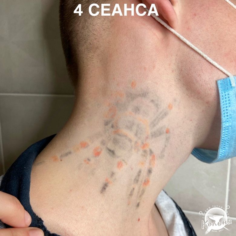 пример удаления татуировки лазером за 4 сеанса