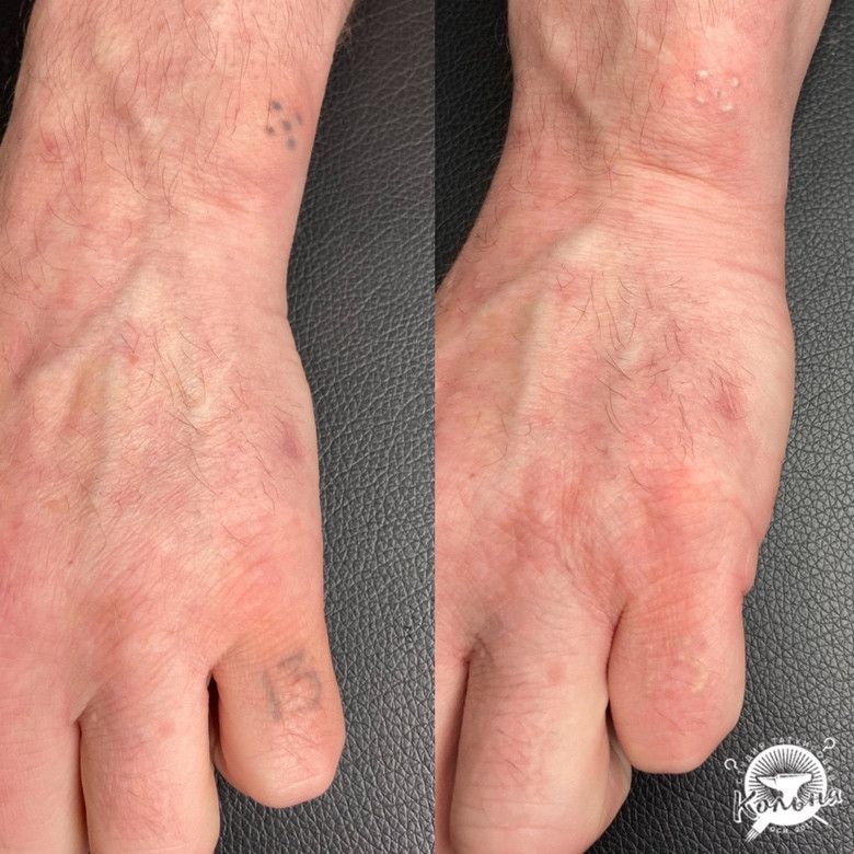 пример лазерного удаления самодельной тату